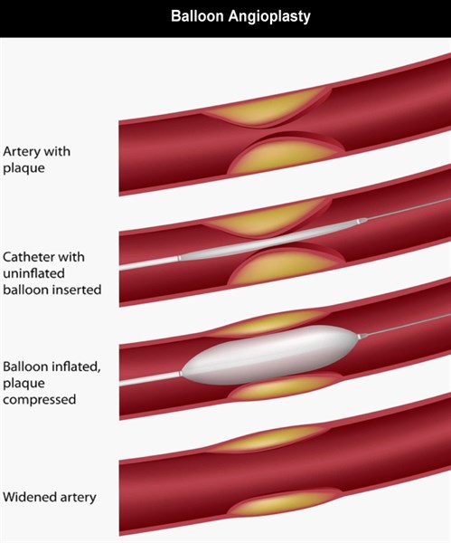 3-a-Patients-ACS-Baloon angioplasty-Black-Investigations